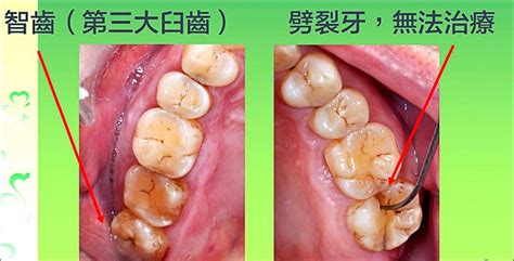 牙齒大顆